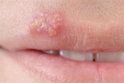 Early Stage Herpes On Lip Treatment Ayurvedic Treatment And Home