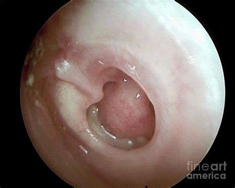 Perforated Eardrum In Ear Infection Photograph By Professor Tony Wright
