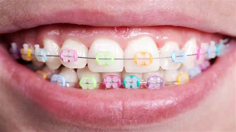 The Best Braces Colors The Comprehensive Guide In 2023