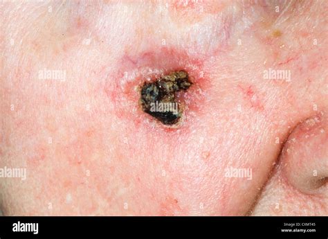 A Basal Cell Cancer Bcc On Cheek With Rolled Pearly Edges