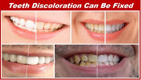 Top 5 Fixes For Your Teeth Discoloration Problem Market Business News