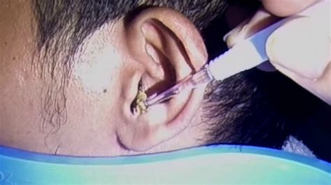 Huge Earwax Blockage Removal Youtube