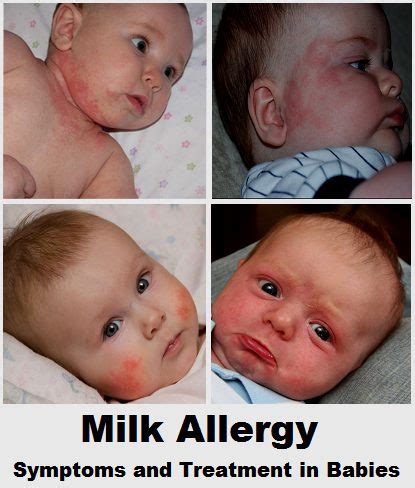 Now infants can get all their vitamin d from their mothers' milk; Milk Allergy Symptoms in Babies (Diet and Treatment ...