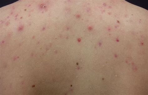 Back Acne Causes And Treatment How To Get Rid Of Acne