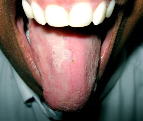 Swollen Tongue A Minor Or Sometimes Dangerous Disorder Youmemindbody