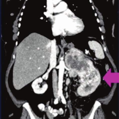 Intravenous Contrast Computed Tomography Ct Scan Showing A Large Left
