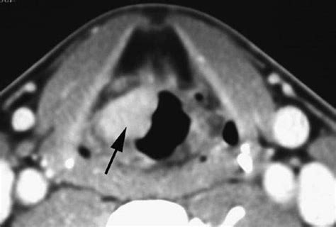 Larynx Benign Noninflammatory Masses And Tumors Radiology Key