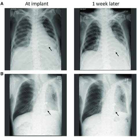 Leadless Transcatheter Pacemaker Position On Chest X Ray A Case 1