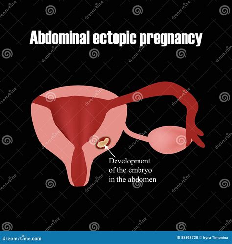 Development Of The Embryo In The Abdomen Ectopic Pregnancy