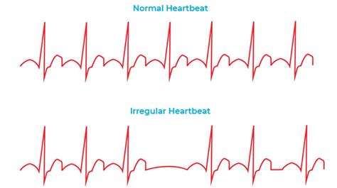 Heart Rhythm Disorders Dr Ks Kishore