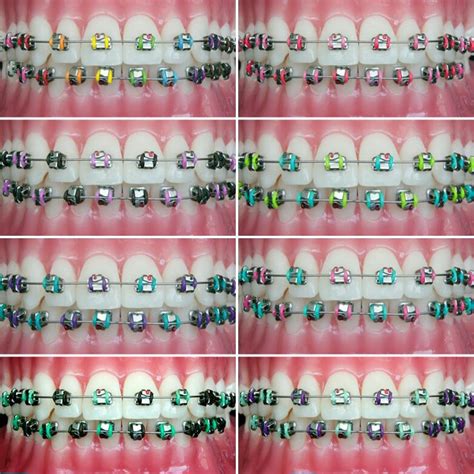 What Colors To Avoid For Braces Warehouse Of Ideas