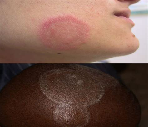 Ringworm Dermatophytosis Causes Symptoms Treatment Diagnosis And