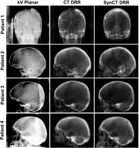 Using Synthetic Ct For Partial Brain Radiation Therapy Impact On Image