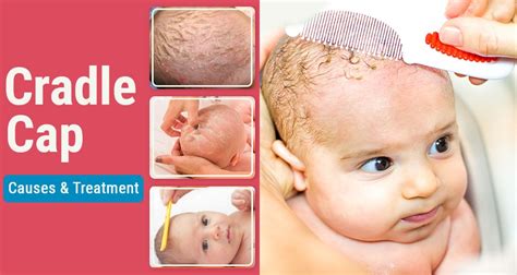 Cradle cap usually clears up on its own in weeks or a few months. All you Need to Know about Cradle Cap in Babies