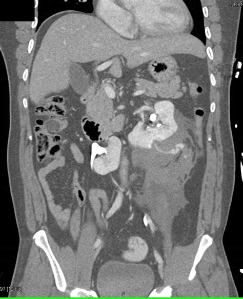 Left Renal Laceration With Hematoma And Contrast Extravasation Trauma