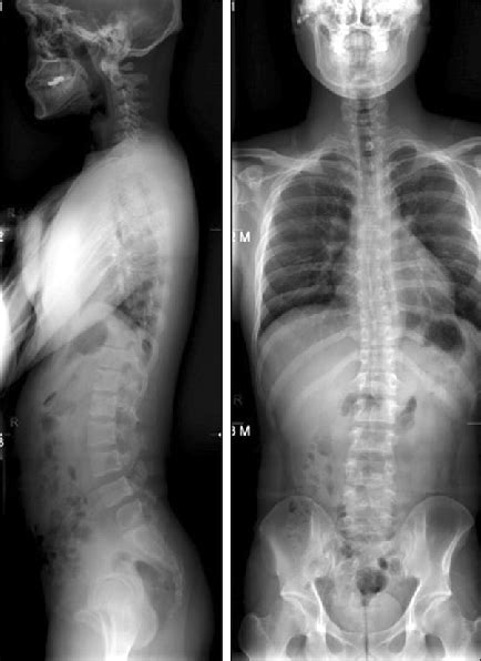 What Does A Normal Lumbar Spine X Ray Look Like Design Talk