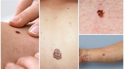 Foto Kako Izgledaju Opasni Mladeži Ljudi Sa Rakom Kože