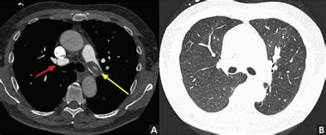 When Does Chest Ct Require Contrast Enhancement Cleveland Clinic