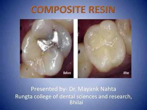 Composite Resin Restoration In Dentistry