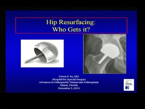 Hip Resurfacing Who Gets It Orthogate
