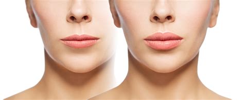 fuller lips without needles lasers make it possible