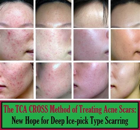 The Tca Cross Method Of Treating Acne Scars New Hope For Deep Ice Pick