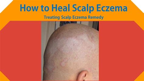 How To Heal Scalp Eczema Treating Scalp Eczema Youtube