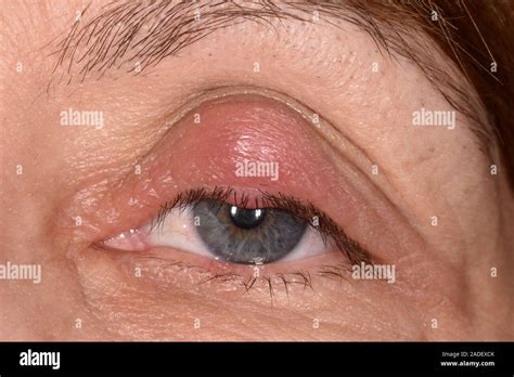 Model Released Chalazion Cyst On An Eyelid In A 54 Year Old Woman