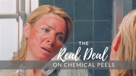 Will A Chemical Peel Make Me Look Like Samantha From Sex And The City Timeless Skin Solutions