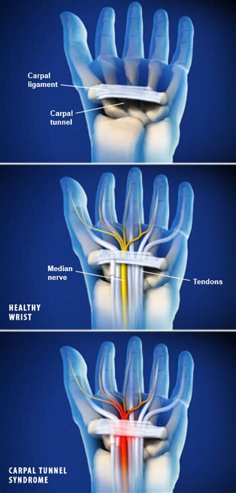 Carpal Tunnel Syndrome Central Coast Orthopedic Medical Group
