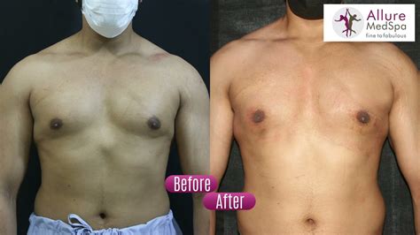 Puffy Nipple Gynecomastia Surgery Experience Under Local Anesthesia By
