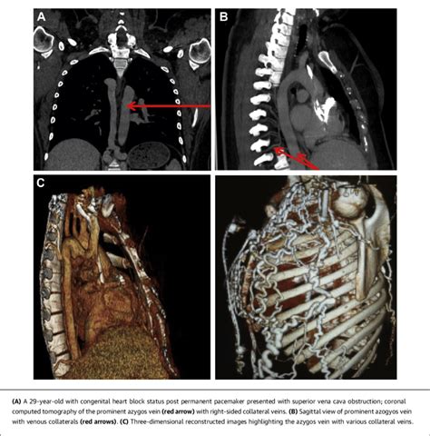 Superior Vena Cava Obstruction From Catheter Related Thrombosis
