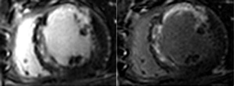 Dual Inversion Recovery Mr Imaging Sequence For Reduced Blood Signal On