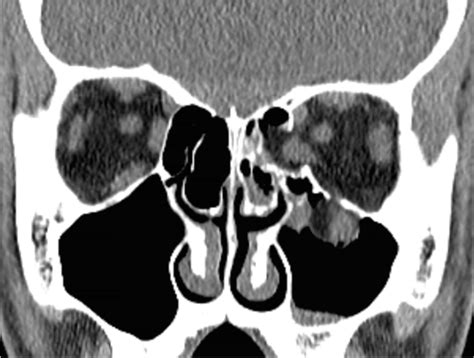 Coronal Ct Image Of A Patient With Left Medial Wall And Orbital Floor