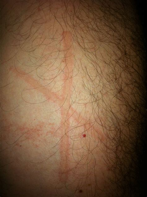 Whether you choose a cold compress, cool showers, or damp cloth, cold water can bring immediate relief and. Hives Rash Treatment in Florida | Hives Skin Allergy