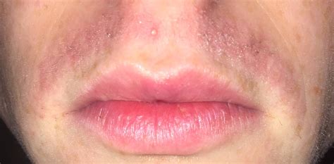 Red Pink And Bumpy Upper Lip Professional Electrolysis