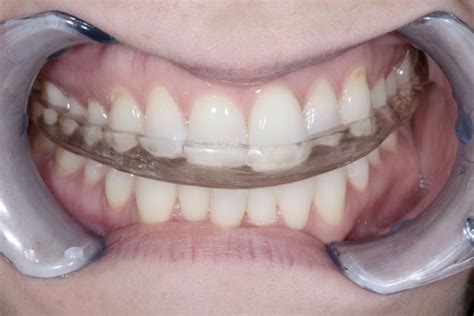 The doctor will select the most appropriate treatment, help restore a beautiful smile. Michigan Splint | News | Dentagama