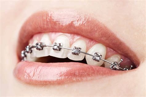 How To Prevent White Spots From Braces Bailey Orthodontics