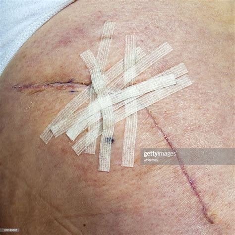 Healing Hip Replacement Wound With Steristrips High Res Stock Photo