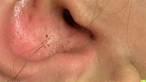 Ear Blackheads Ear Extractions Concha Pops Cleaning Out The Ear