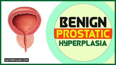 Benign Prostatic Hyperplasia How To Treat BPH Naturally YouTube