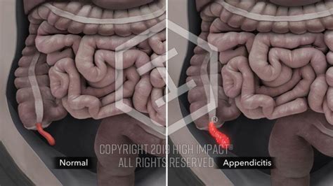 7 Figure Settlement Animated Appendix Rupture After Botched