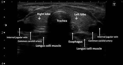 Ultrasonographic Imaging Of A Normal Thyroid Gland Transverse Section