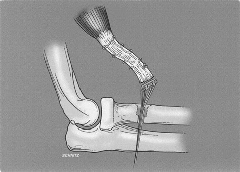 Endobutton Assisted Repair Of Distal Biceps Tendon Ruptures Journal
