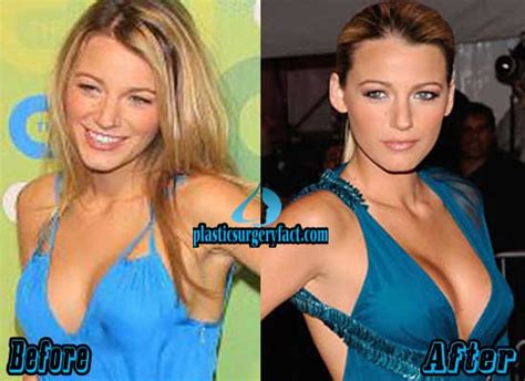Best Boob Jobs In Hollywood Before And After Photos