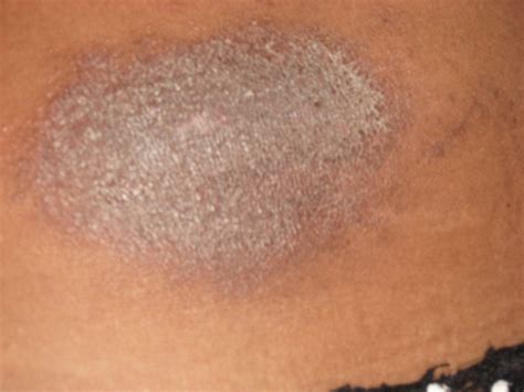 Itchy Dark Spots On Skin