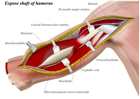 Can create an articular length mismatch knowledge. Anterior (Brachialis Splitting) Approach to Humerus ...