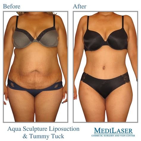Tummy Tuck Lipo Before And After Medilaser Surgery And Vein Center