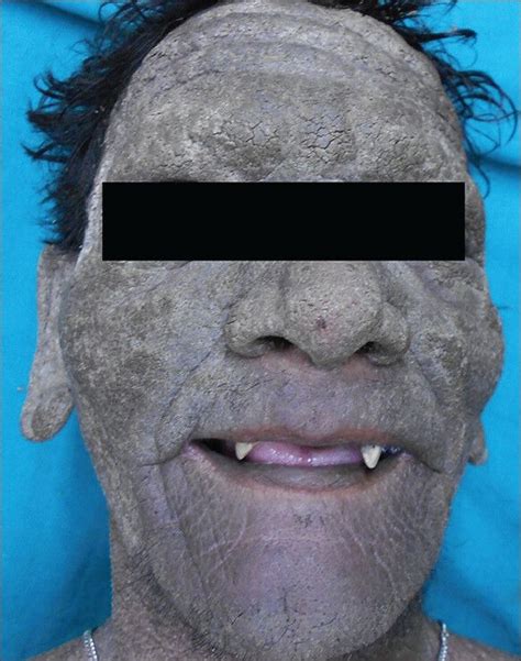 A Case Of Ichthyosis Hystrix Unusual Manifestation Of This Rare Disease Abstract Europe Pmc