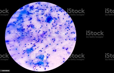 Sputum Smear Under Microscopy Showing Gram Positive Cocci Bacteria